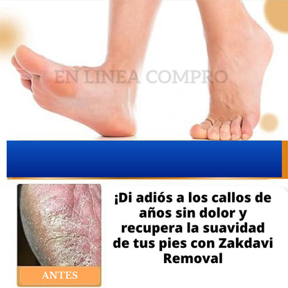 🔥👉DILE ADIOS A LOS PIES CALLOSOS 🦶CONZAKDAVI  REMOVAL SPRAY ELIMINADOR DE CALLOS 🤩💫